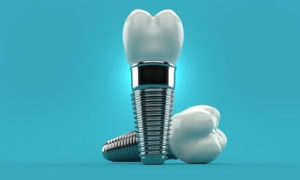 ALL YOU NEED TO KNOW ABOUT DENTAL IMPLANT IN DENTISTRY