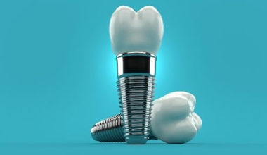 ALL YOU NEED TO KNOW ABOUT DENTAL IMPLANT IN DENTISTRY