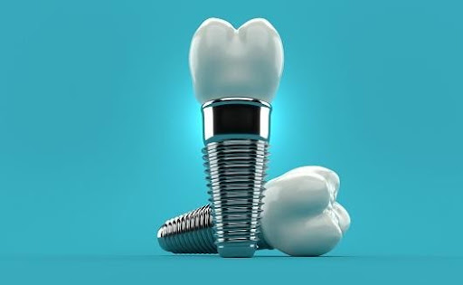 ALL YOU NEED TO KNOW ABOUT DENTAL IMPLANT IN DENTISTRY