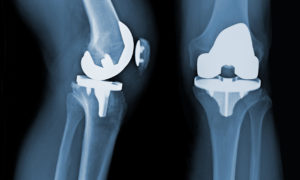 The Exactech Recall and the Future of Knee Replacement Surgery