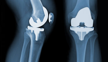 The Exactech Recall and the Future of Knee Replacement Surgery