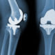 The Exactech Recall and the Future of Knee Replacement Surgery
