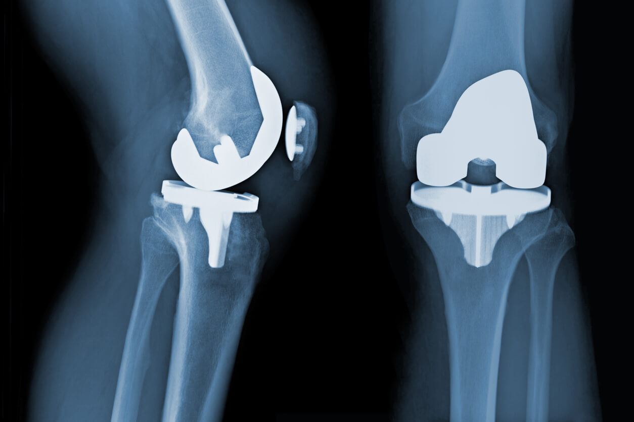 The Exactech Recall and the Future of Knee Replacement Surgery
